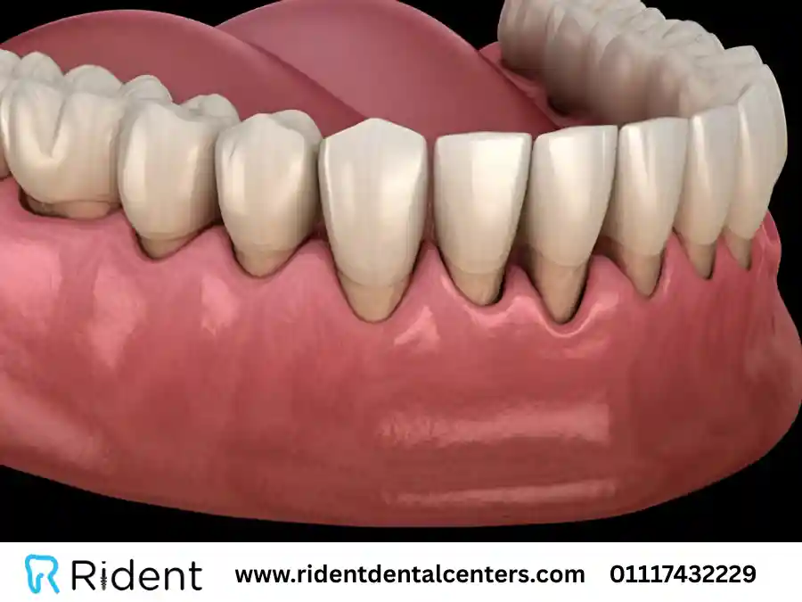 نزول اللثة و10 طرق لعلاج تعري الأسنان